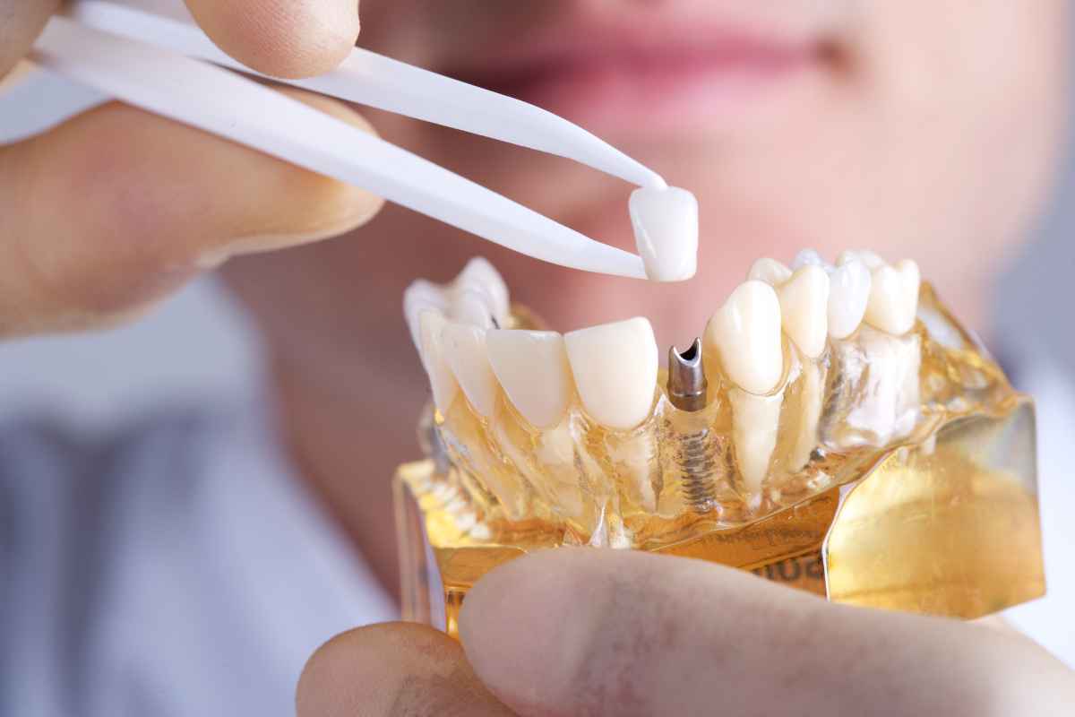 postoperatorio implantes dentales