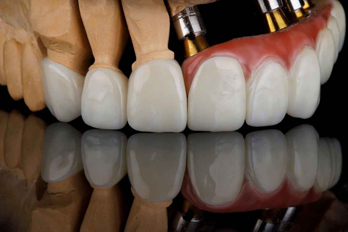 carillas dentales estéticas