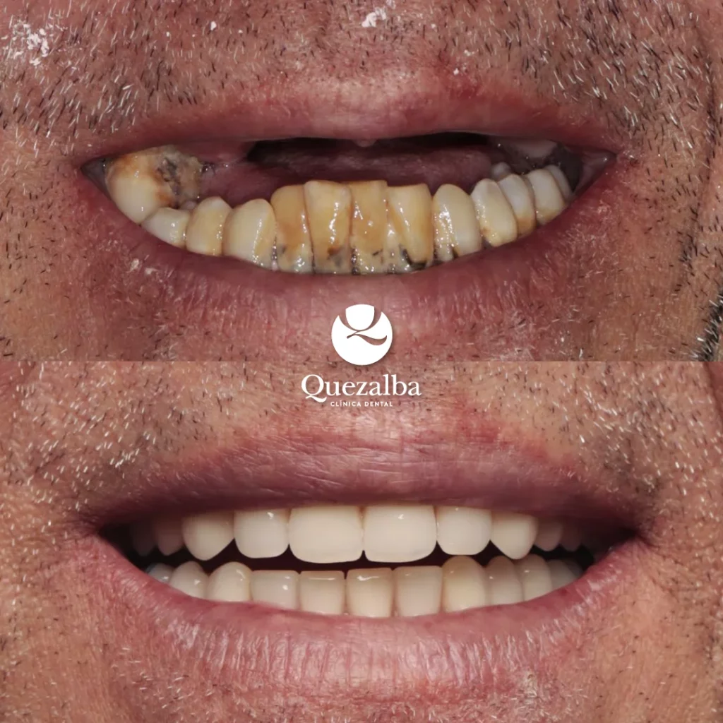 Comparativa Juan José