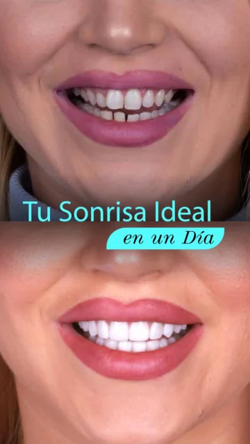 4_SONRISAS_Tu_sonrisa_ideal_en_un_día